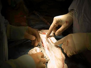 News_Houston Memorial Hermann Hospital_vein_tweet_open-heart surgery