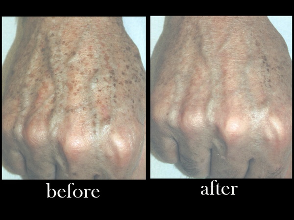 Austin Photo Set: dr. zimmet_skin treatment_feb2013_hand