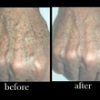Austin Photo Set: dr. zimmet_skin treatment_feb2013_hand