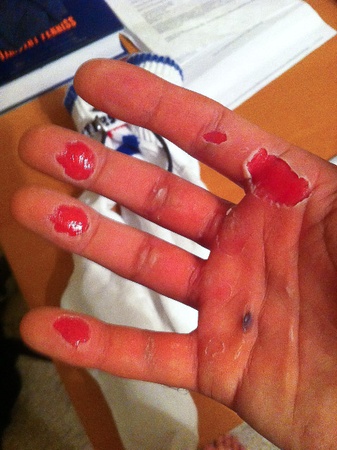 News_Crossfit_hand_blisters